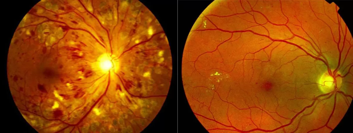 Retinopatia Diabética